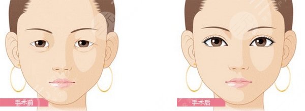 長沙希美醫(yī)療美容怎么樣？兩位醫(yī)生強項介紹，雙眼皮案例測評！