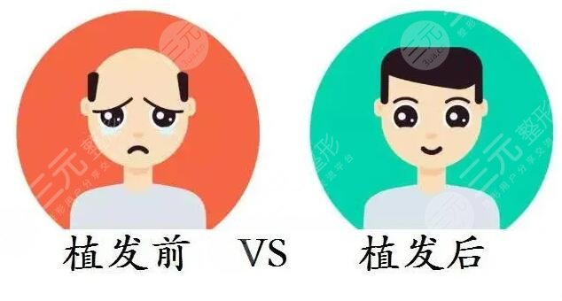 上海仁濟(jì)醫(yī)院植發(fā)中心發(fā)際線(xiàn)改良案例