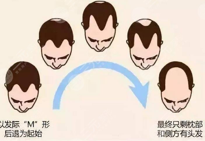 上海九醫(yī)院植發(fā)案例