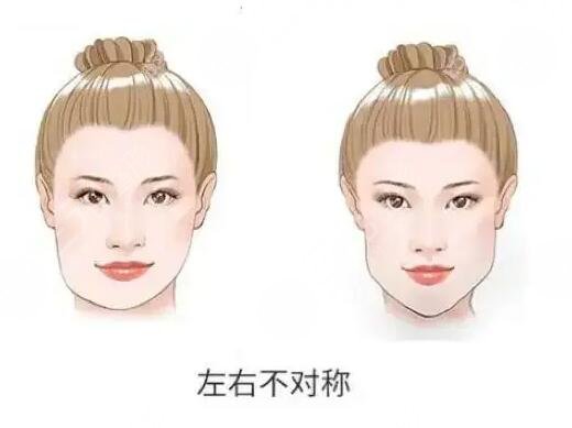 下頜骨一高一低臉歪怎么矯正？左右臉不對(duì)稱能矯正過來(lái)嗎？