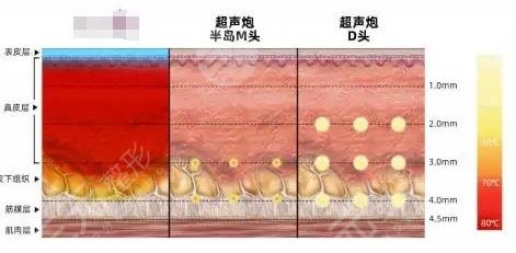 半島黃金超聲炮和超聲炮的區(qū)別有哪些？