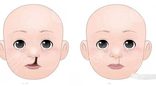 三大知名的唇腭裂專家是誰？