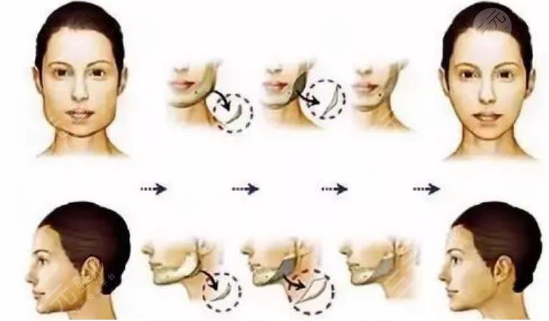 崔榮達(dá)醫(yī)生磨骨案例分享