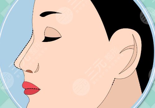 鐘青杰醫(yī)生做雙眼皮怎么樣