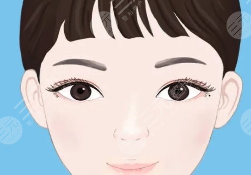 鐘青杰醫(yī)生做雙眼皮怎么樣