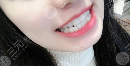 上海第十人民醫(yī)院牙科隱形矯正案例分享