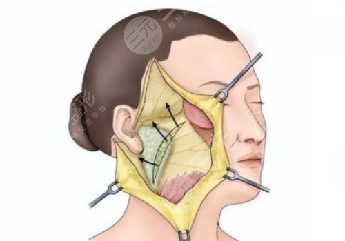 筋膜懸吊提升術(shù)能保持多久
