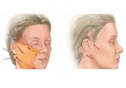 筋膜懸吊提升術(shù)能保持多久