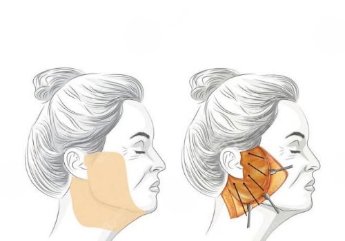 筋膜懸吊面部提升術(shù)價格