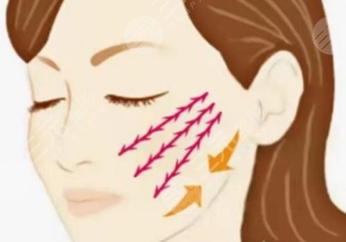 筋膜懸吊面部提升術(shù)價格