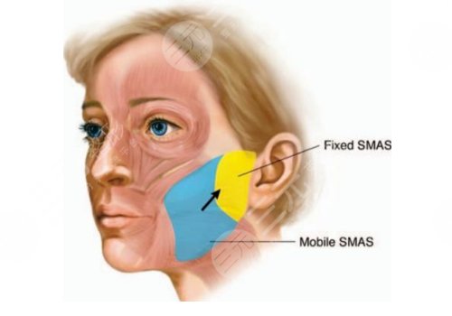 小切口拉皮手術(shù)費(fèi)多少錢