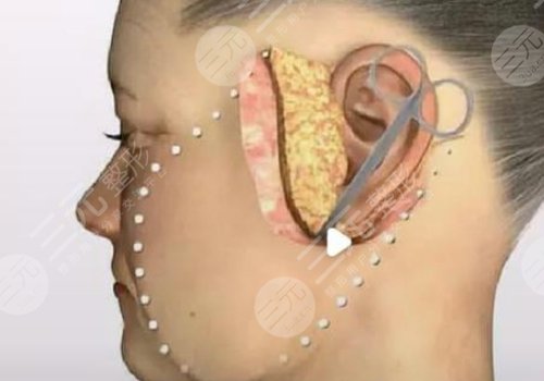小切口拉皮手術(shù)費(fèi)多少錢