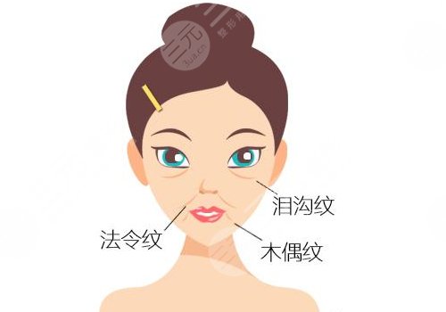 淚溝法令紋怎么改良