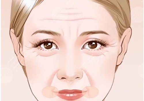 淚溝法令紋怎么改良