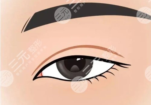 小切口雙眼皮能堅(jiān)持幾年