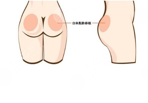 脂肪豐臀多久能恢復好？