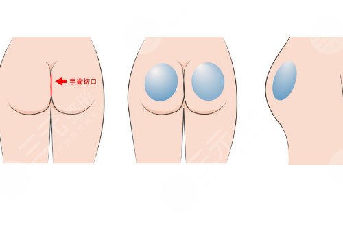 脂肪豐臀多久能恢復好
