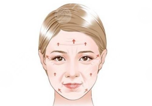 筋膜懸吊面部提升和拉皮的區(qū)別