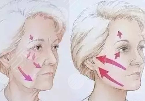 筋膜懸吊面部提升和拉皮手術(shù)的區(qū)別