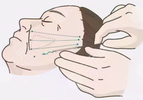 筋膜懸吊面部提升和拉皮的區(qū)別