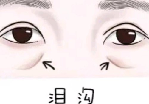 淚溝凹陷怎么解決好？