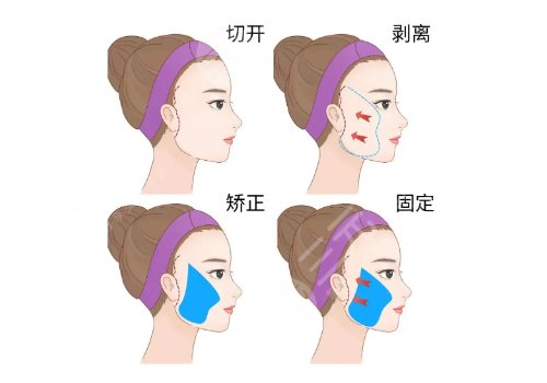 小切口拉皮手術可以維持多久