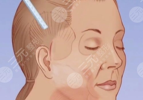 筋膜懸吊術(shù)可以維持幾年