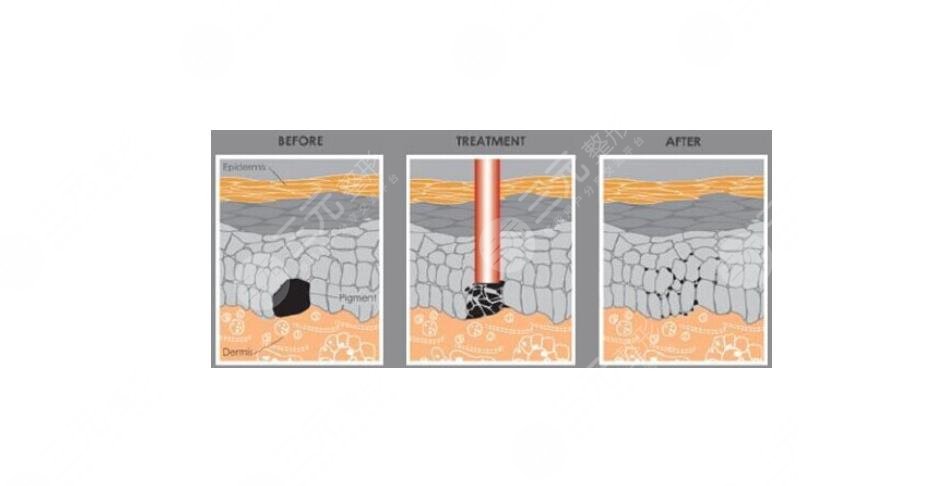 陳立彬?醫(yī)生做疤痕疙瘩的手術(shù)怎么樣?