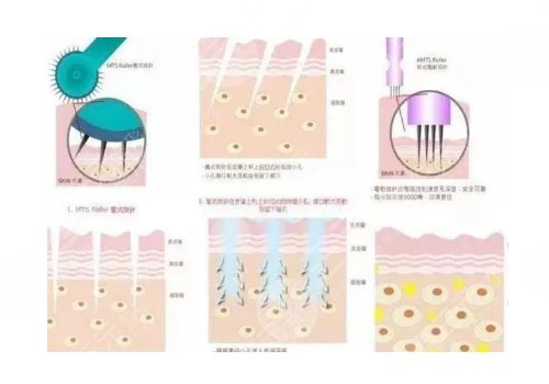 鐳射凈膚儀祛斑會(huì)反彈嗎