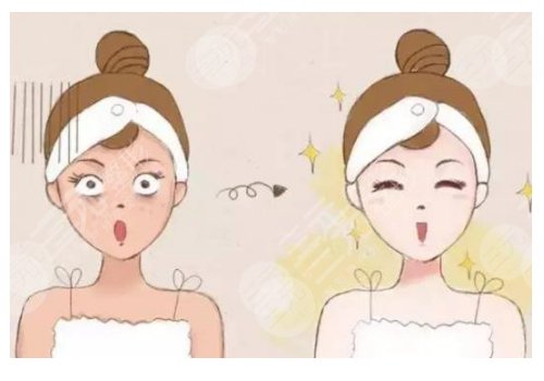 鐳射凈膚儀祛斑會(huì)反彈嗎