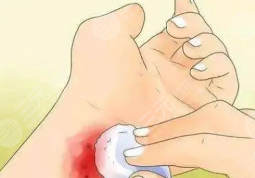 鐳射凈膚儀祛斑有副作用嗎？