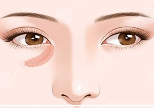 脂肪填充淚溝5到10天照片案例