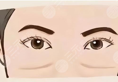 脂肪填充淚溝5到10天照片案例分享來(lái)啦