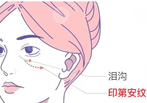 脂肪填充淚溝5到10天照片案例分享來(lái)啦