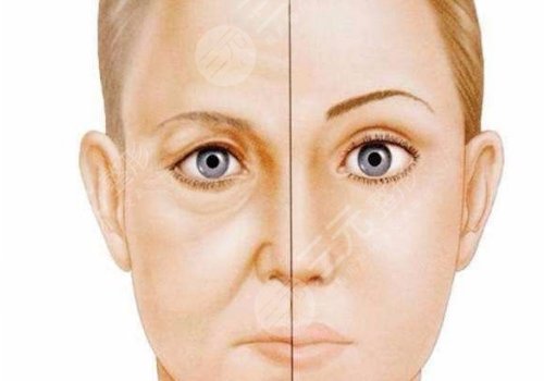 脂肪填充淚溝5到10天照片案例分享來(lái)啦