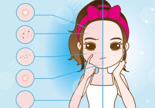 鐳射凈膚儀祛斑一次有效果嗎