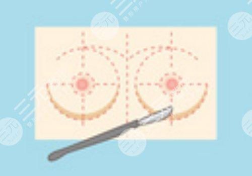 曼托假體好不好？