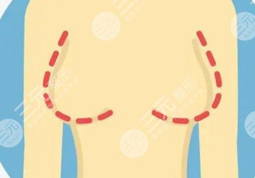 曼托假體好不好？