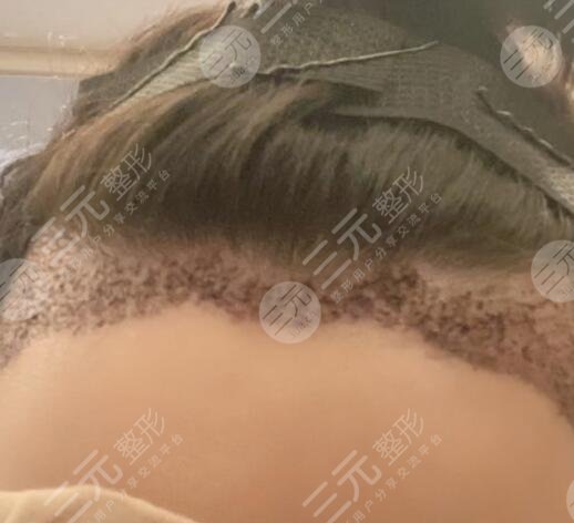 武漢同濟(jì)醫(yī)院植發(fā)科發(fā)際線移植案例分享