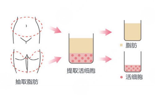 額頭填充有風(fēng)險(xiǎn)嗎