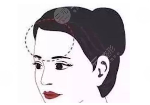 額頭填充有風(fēng)險(xiǎn)嗎