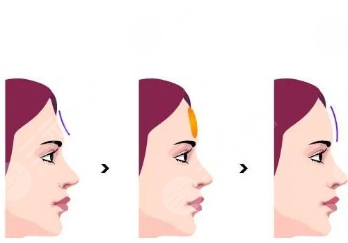 額頭填充膠原蛋白多久恢復(fù)正常
