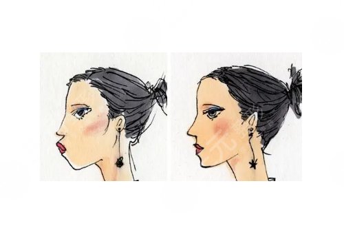 額頭填充一般維持多久