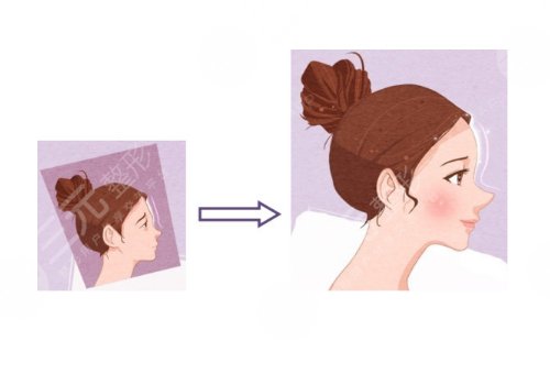 額頭填充一般維持多久