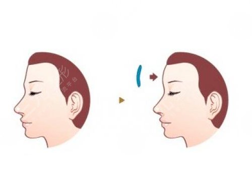 額頭填充一般維持多久