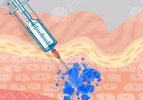 馨妍玻尿酸的優(yōu)缺點(diǎn)