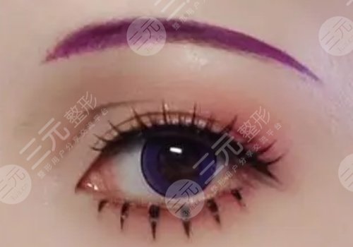 梁奕敏雙眼皮修復案例