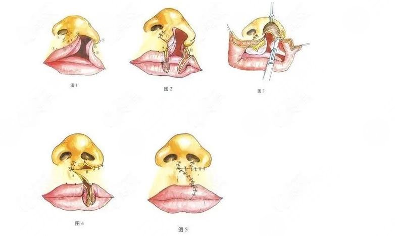 范鍇醫(yī)生做唇裂二次修復(fù)怎么樣啊?