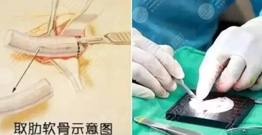 廣州藝美整形醫(yī)院科普知識(shí)