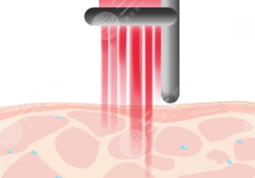 南京藝星醫(yī)療美容醫(yī)院祛痣多少錢